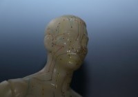 Acupuncture